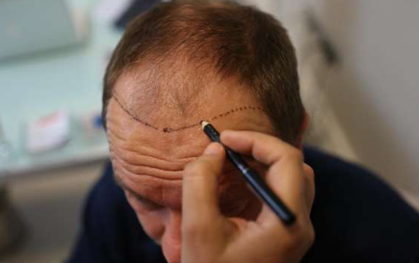 Calculating the Cost of Hair Transplant in Ludhiana